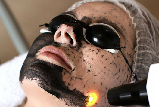 Peeling Laser de Carbono Black Peel